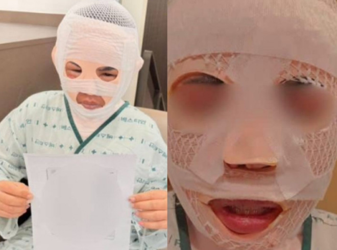 잠을 자고 있던 태국인 아내의 얼굴에 끓는 물을 부어 화상을 입힌 40대 한국인 남성에게 검찰 구형보다 무거운 징역 3년 6개월이 선고됐다. 사진은 피해자가 심각한 화상을 입은 모습. 페이스북 캡처