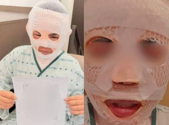 잠을 자고 있던 태국인 아내의 얼굴에 끓는 물을 부어 화상을 입힌 40대 한국인 남성에게 검찰 구형보다 무거운 징역 3년 6개월이 선고됐다. 사진은 피해자가 심각한 화상을 입은 모습. 페이스북 캡처