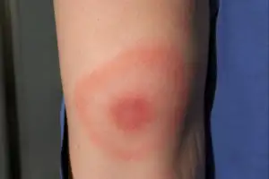 thumbnail - “정부가 하늘에서 살인 진드기 살포 중”…환자 50배 폭증, 음모론까지
