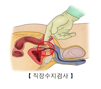 전립선암을 진단할 때는 의사가 손가락을 항문에 넣어 촉진하는 직장수지검사법이 가장 많이 쓰인다. 그렇지만 환자들의 심리적, 신체적 부담을 호소하는 경우가 많다. 서울아산병원 제공