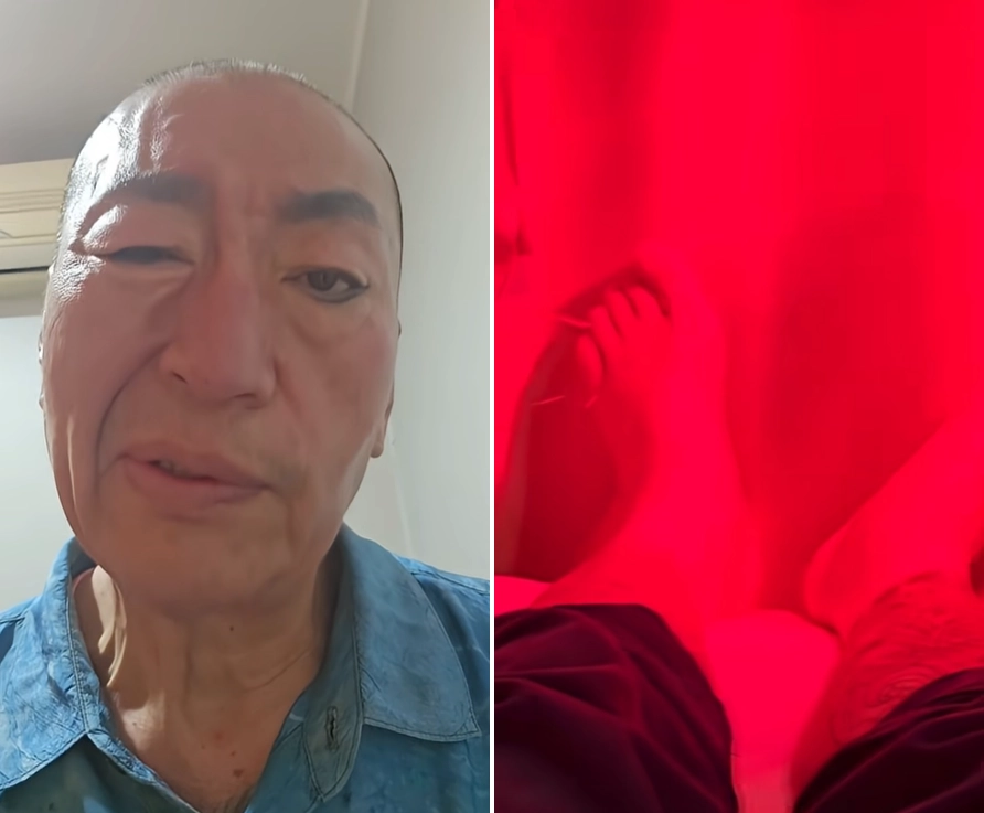 배우 겸 방송인 유퉁이 지난 1일 “눈이 안 감기고 입이 돌아가 치료받고 있다”며 안면마비 증세를 호소했다. 오른쪽 사진은 유퉁이 한방병원에서 발에 침을 맞으며 적외선 치료를 받는 모습. 유튜브 채널 ‘유퉁TV’ 캡처