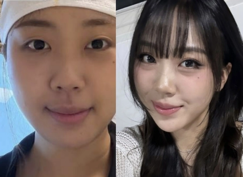 래퍼 이영지가 눈밑 지방 재배치 시술 근황을 전했다. 왼쪽 사진이 시술 받은 지 3개월 차 모습. 이영지 인스타그램 캡처