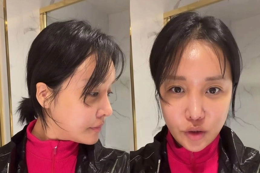 방송인 랄랄은 최근 눈밑 지방 재배치 시술과 코 수술을 받았다고 밝혔다. 랄랄 인스타그램
