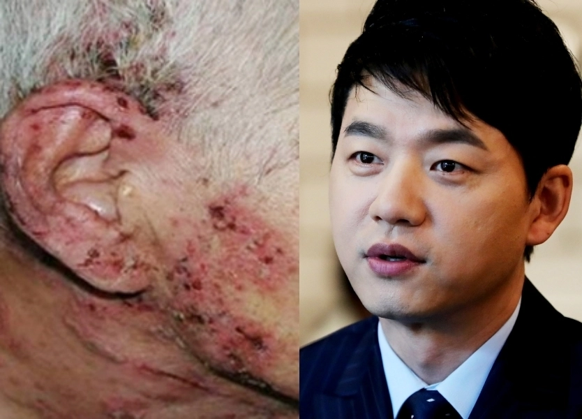 배우 김승수가 대상포진에 걸렸던 일화를 전했다. 왼쪽부터 질병청 ‘대상포진’ 자료사진,연합뉴스.