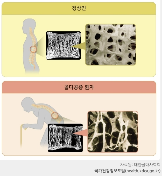 정상인과 골다공증 환자의 뼈 상태 비교. 질병관리청 국가정보포털 홈페이지 캡처.