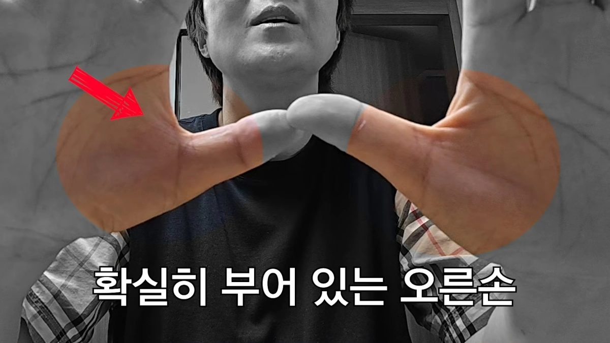 방송인 송은이가 최근 ‘방아쇠 수지 증후군’으로 수술을 받은 근황을 공개했다. 유튜브 채널 ‘VIVO TV - 비보티비’ 캡처