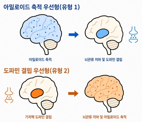 루이소체치매 진행유형 구분
