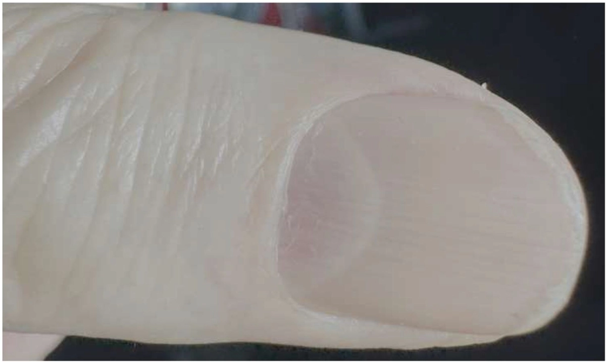 겉보기에 건강한 77세 남성의 붉은색 손톱반달. 논문 캡처