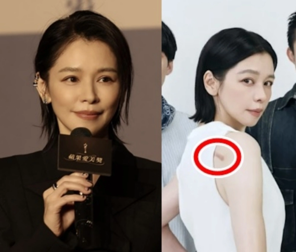 대만 가수 겸 배우 비비안 수(쉬뤄쉬안)가 두개안면기형 환자들을 돕는 자선단체의 사진전에서 민소매옷을 입고 등에 난 흉터를 공개했다. 이 흉터는 외상 또는 수술 등으로 난 상처가 과도한 흉터로 남은 ‘켈로이드’로, 그는 흉터를 가리기 위해 20여년 동안 민소매옷을 입지 못했다고 고백했다. 자료 : 쉬뤄쉬안 인스타그램·노르드호프 두개안면재단