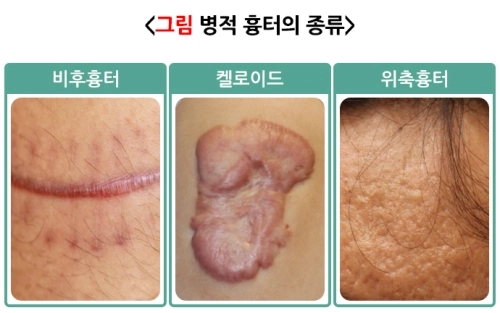 병적 흉터의 종류. 자료 : 질병관리청
