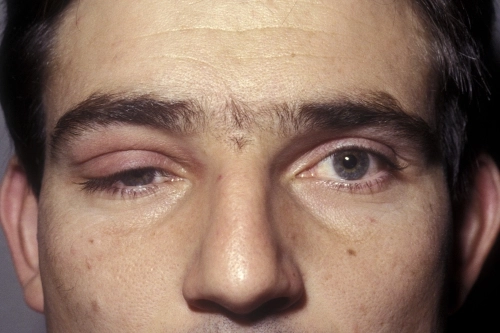 Drooping eyelid