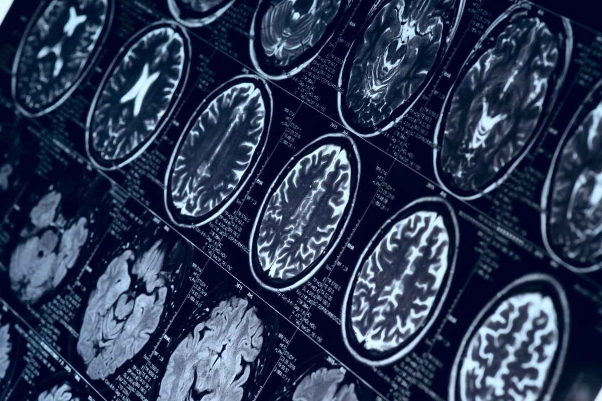 자기공명영상(MRI)으로 촬영한 뇌 사진. 123rf