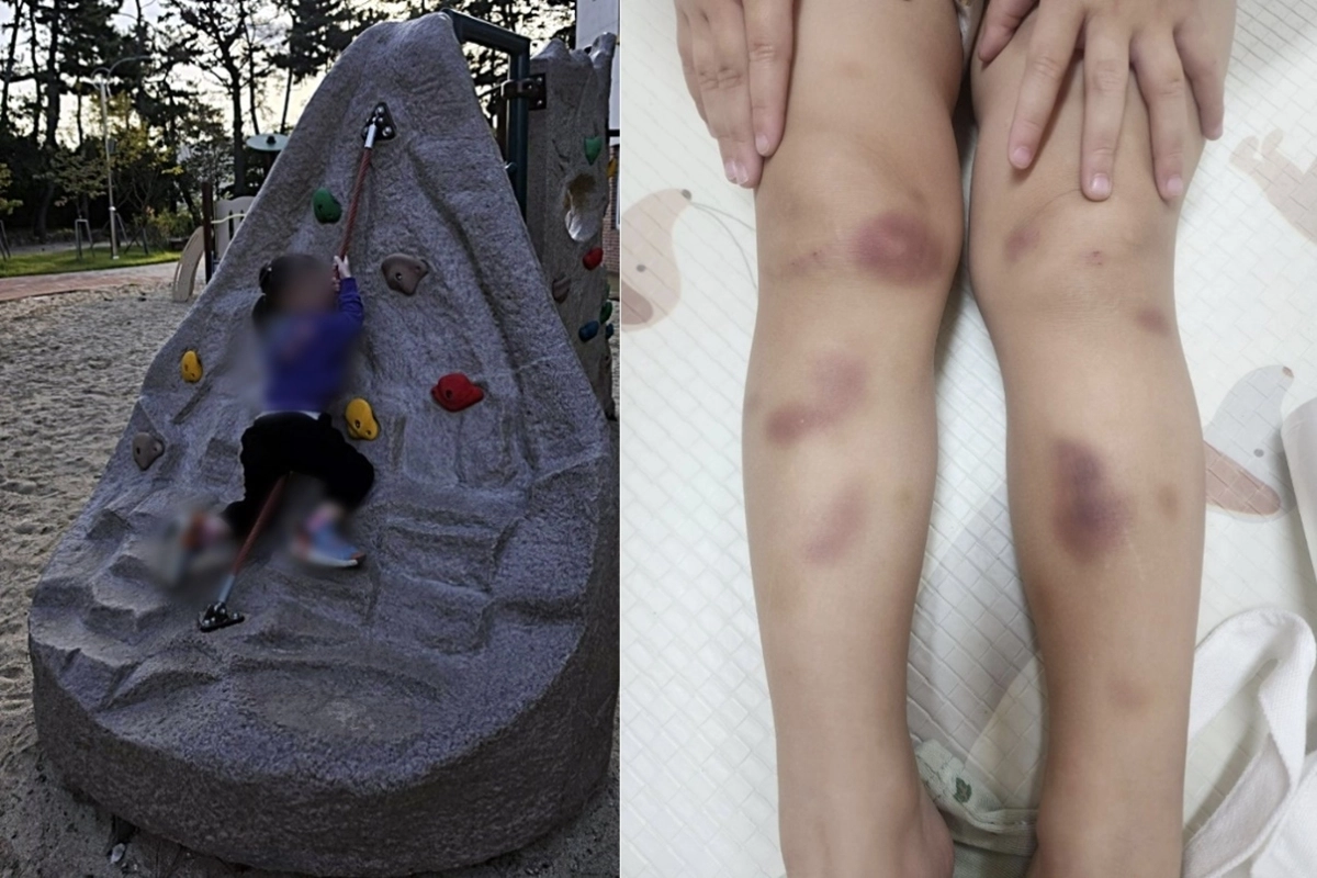 밧줄놀이를 한 뒤 다리에 멍이 생긴 33개월 딸이 아동학대 의심 신고로 부모와 분리됐다는 주장이 제기됐다. 보배드림 캡처